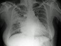 Polmonite: raggi X torace (ANSA)