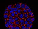 Cellule tumorali del pancreas (fonte: Min Yu,USC Norris Comprehensive Cancer Center) (ANSA)