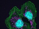 Cellule di un tumore della pelle (fonte: Catherine e James Galbraith, Oregon Health and Science University, Knight Cancer Institute, da Flickr) (ANSA)