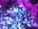 Cellule di neuroblastoma (fonte: Max Nobis / Garvan) (ANSA)
