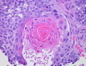 Cellule del tumore al polmone (fonte: Atlas of Pulmonary Pathology, da Flickr) (ANSA)
