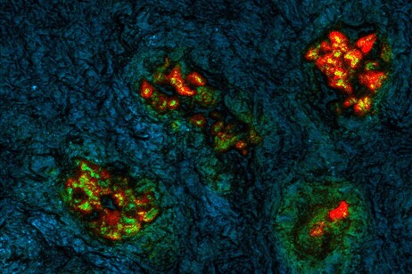 In rosso cellule tumorali del colon-retto che hanno formato metastasi nel fegato (fonte: Mass General Brigham)