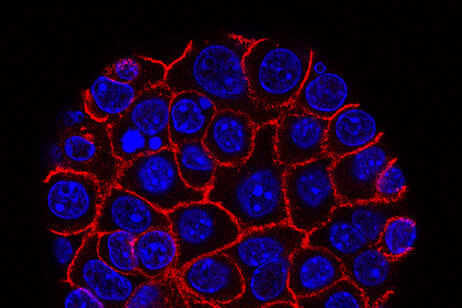 Cellule del tumore del pancreas (fonte: Min Yu/Eli and Edythe Broad Center for Regenerative Medicine and Stem Cell Research at USC,USC Norris Comprehensive Cancer Center, Pancreatic Desmoplasia, da Flickr)