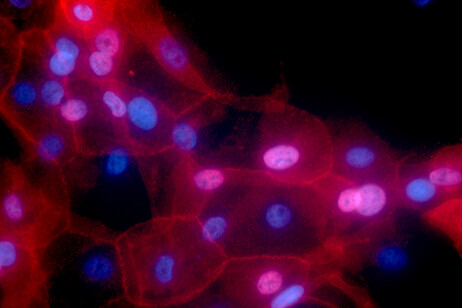 Cellule del tumore del seno (fonte: Ewa Krawczyk, NCI/ Georgetown Lombardi Comprehensive Cancer Center, NIH, da Flickr)