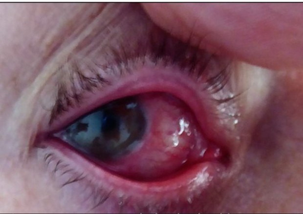 Rara e grave infezione dell'occhio © Ansa