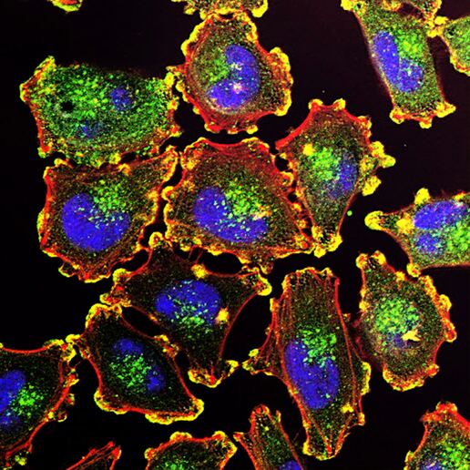 Cellule tumorali (fonte: Unsplash) - RIPRODUZIONE RISERVATA