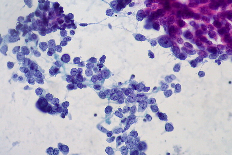 Cellule dell 'adenocarcinoma del polmone (fonte: Ed Uthman from Houston, TX, USA, da Wikipedia) -     RIPRODUZIONE RISERVATA