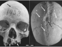 Il cranio di una donna vissuta in Italia nel Medioevo mostra i segni del primo caso mai scoperto di chirurgia cranica (fonte: Sapienza Università di Roma) (ANSA)