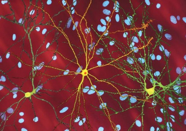 Neuroni di un soggetto colpito da Corea di Huntington (fonte: Dr. Steven Finkbeiner, Gladstone Institute, Taube-Koret Center and the University of California San Francisco) © Ansa