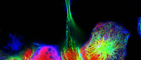 Cellule di neuroblastoma (fonte: vshivkova, da iStock)