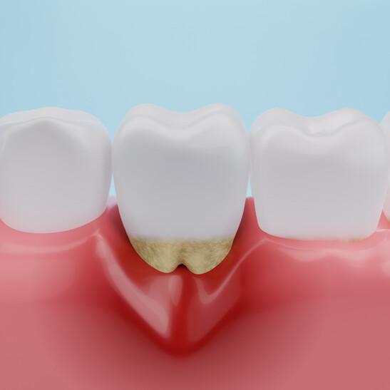 Anche chi ha la parodontite può prendere i farmaci salva-ossa