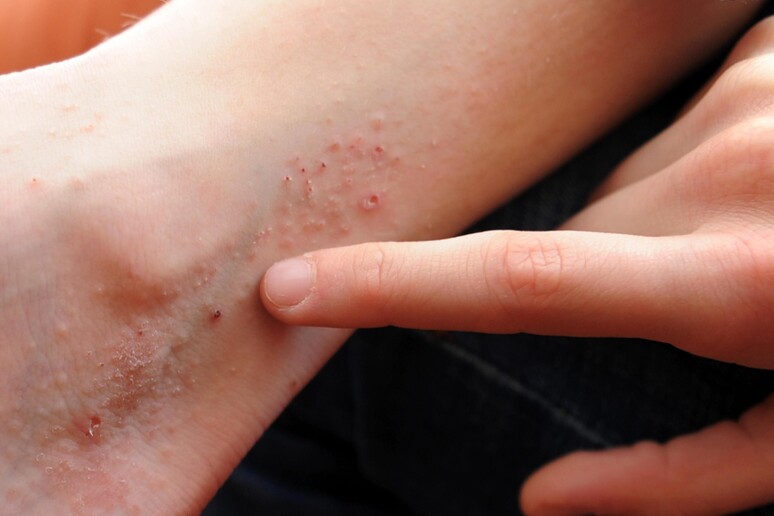 Eczema, colpisce il 6% di bambini e adolescenti nel mondo - RIPRODUZIONE RISERVATA